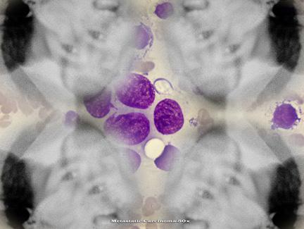 Metastatic-carcinoma-50x