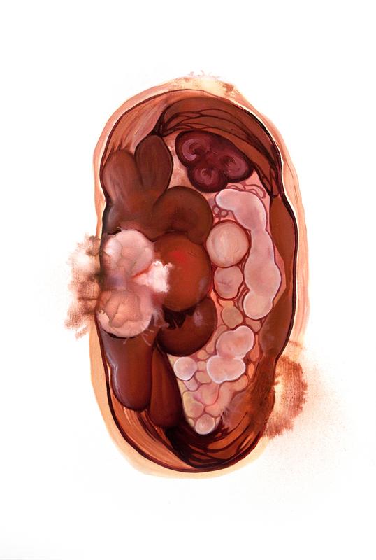 You will be asked to sign a consent form that says you do not have any of these items in your body. You will be asked to sign a consent form that says you do not have any of these items in your body.