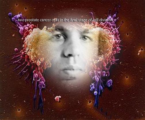 Two prostate cancer cells